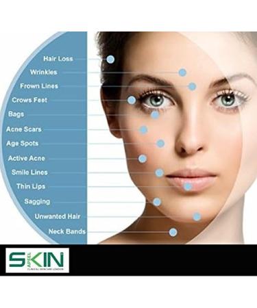 NEW Skinapeel 192 Derma Needle Roller - Professional Titanium Microneedle Treating - Acne Scars Hair Loss Wrinkles Blackheads Ageing - Reducing Blemishes Cellulite Stretch Marks - Home Use (1.0mm) - Buy Online on GoSupps.com