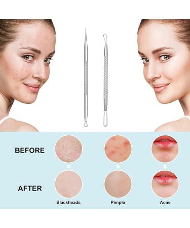 Blackhead Remover 2 PCS Pimple Popper Tool Stainless Steel Pimple Extractor Blackhead Removal Tool Risk Free Treatment for Blemish Whitehead Popping Blemish - Buy Online on GoSupps.com
