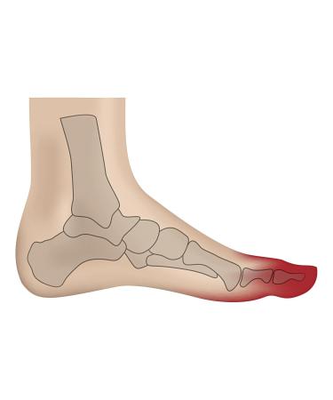GOFORM Hallux Valgus Night Splint for Big Toe Misalignment - Size 2 (41-46) | Left Foot Correction Aid | International Shipping Available - Buy Online on GoSupps.com