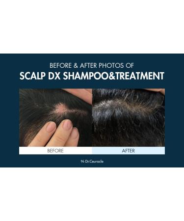 Dr.Ceuracle Scalp DX Voluming Treatment | Anti-Hair Loss Volume Care | Intensive Hair Mask with Collagen and Keratin | Strengthen Scalp Hair | leegeehaam Cosmetics - Buy Online on GoSupps.com