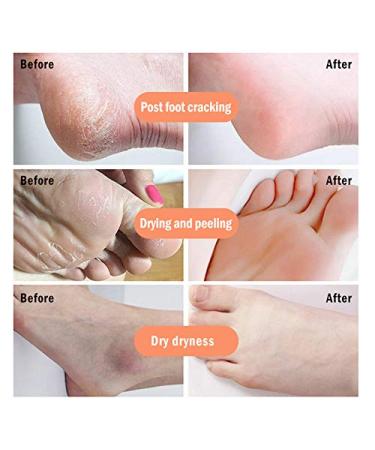 ZSGG 2-Pack Banana Oil Foot Cream for Dry Cracked Heels - Moisturizing Skin Care Treatment - Buy Online on GoSupps.com