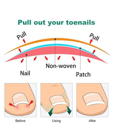 60 Pcs Toenail Correction Patch - Ingrown Toenail Corrector Tools for Perfect Pedicure - Buy Online on GoSupps.com