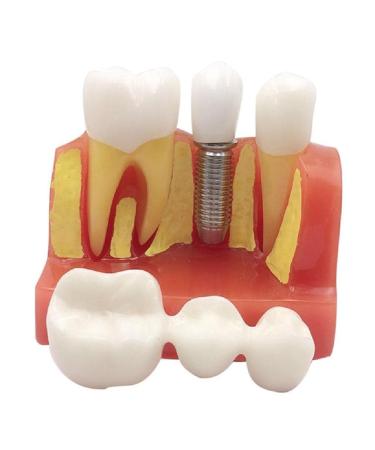 Dental implant analysis crown bridge model 4 times dental implant teeth model with removable crown dentists patient implant teeth model red