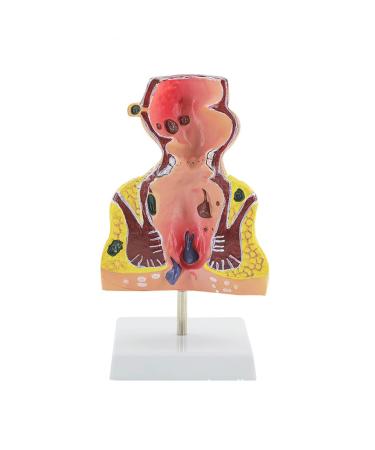 Human Anorectal Pathology Model Hemorrhoid Lesion Model Hemorrhoid Anal Fistula Lesion Model Rectal Medical Education/Product Education