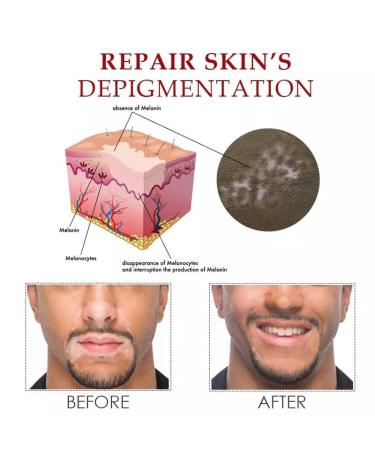 NONROT Vitiligo Skin Repair Spray - Reduces White Spots - 4 Count (Pack of 4) - Buy Online on GoSupps.com