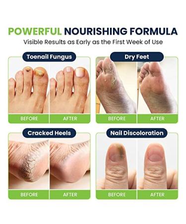 Extra Strength Toenail Fungus Treatment Kit - Foot Soak, Nail Repair Pen, Tea Tree Balm - Made in USA - Effective Solution for Smelly Feet, Athletes Foot, Cracked Nails - Buy Online on GoSupps.com