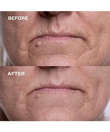 Wrinkles Schminkles Mouth & Lip Wrinkle Patch 2-Pack - Silicone Smoothing Pads for Lip Wrinkle Prevention - Hypoallergenic & Reusable - 1 Pair - Buy Online on GoSupps.com