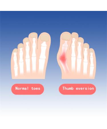 Bunion Corrector for Women & Men - Big Toe Pain Relief Hallux Valgus Splint Socks & Orthopedic Support Brace - Buy Online on GoSupps.com