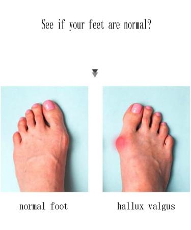 DEAVER Toe Separators for Overlapping Toes - Clear Gel Straighteners for Pain Relief and Bunion Correction - Buy Online on GoSupps.com