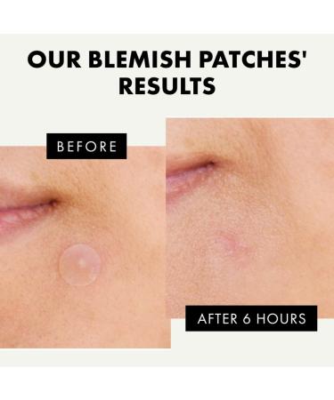 Hydrocolloid Acne Patches - 72 Count | Blemish & Zit Cover | Day & Night Acne Treatment | Invisible Pimple Patch by Eclat - Buy Online on GoSupps.com