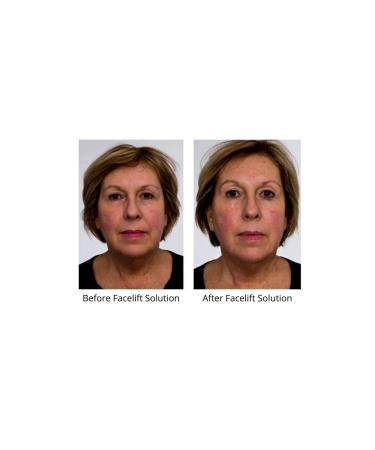 Dr. Sevinor Plastic Surgeon 8oz Genuine Face Lift Solution All Skin Types 8 fl. oz. More for Less Feel the Confidence! - Buy Online on GoSupps.com