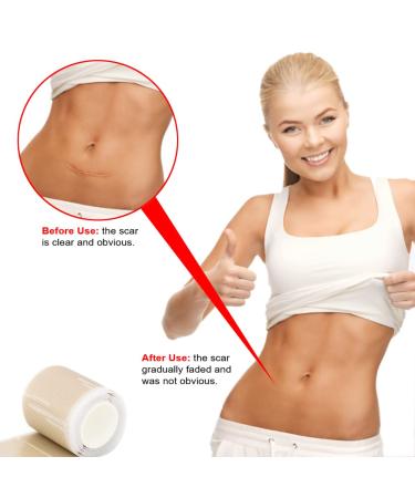 IGOOLEE Silicone Scar Sheets Strips Tape - 3 Reusable Rolls for Surgical Scar Removal - 1.57 x 120 Size - Ideal for Keloid & C-Section Scars - Buy Online on GoSupps.com