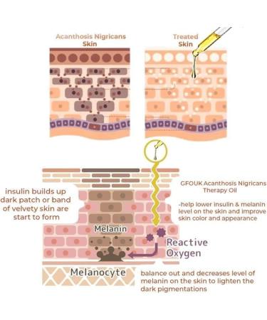 Acanthosis Nigricans Huile de th rapie pour corriger les taches sombres traitement de l'acanthose nigricans limine les taches sombres pour claircir le corps et la peau noire (1 pi ce) 1 pi ce. - Buy Online on GoSupps.com