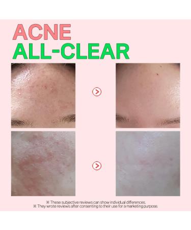 ATOMU Mildly Alkaline Oily Acne Sebum Removal Deep Cleansing ACLIS Foam Cleanser - 4.05 fl.oz | International Shipping Available - Buy Online on GoSupps.com