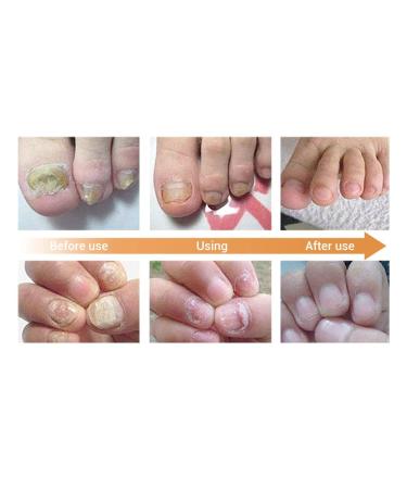 Maximum Strength Nail Fungus Repair Treatment - Natural Formula for Toenail and Fingernail Repair - Buy Online on GoSupps.com