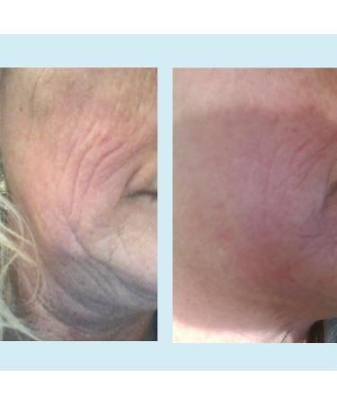 Lactic 50% Gel Peel - Chemical Exfoliant for Face Remove Breakout Scars Strength Level 2 1 oz - Perfect Image - Buy Online on GoSupps.com