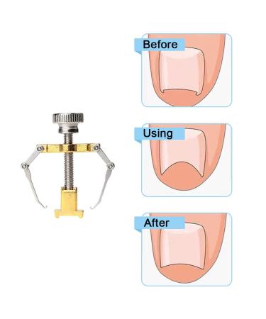 Ingrown Toenail Corrector & Lifter - Professional Toe Clamp for Effective Treatment - Buy Online on GoSupps.com