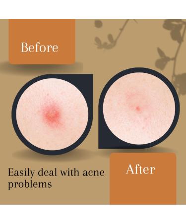 Hydrocolloid Acne Pimple Patch with Tea Tree Oil | 72 Invisible Zit Patches for Effective Blemish Treatment | Includes Tweezer for Safe Application | Spot Healing Care - Buy Online on GoSupps.com