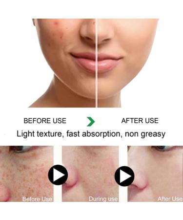 2PCS Fuyan Whitening and Anti-Freckle Cream Cr me blanchissante et anti-taches de rousseur Fuyan Cr me anti-rides hydrate et claire la peau cr me antipigmentation pour le visage - Buy Online on GoSupps.com