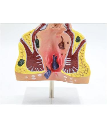 Human Anorectal Pathology Model Hemorrhoid Lesion Model Proctology Hemorrhoid Anal Fistula Lesion Model for Medical Teaching/Education Supplies - Buy Online on GoSupps.com