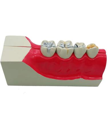 Croix Dentaire Molar Section | Oral Simulation Teeth Model for Dental Study | Educational Dental Model with Nerve Line for Tissue Dissection - Buy Online on GoSupps.com