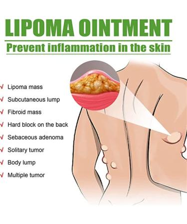 YSGBYSG LipomaCure Ointment 20g - 5PCS | Lump-Free Lipoma Removal Cream for Skin Anti-Swelling - Buy Online on GoSupps.com