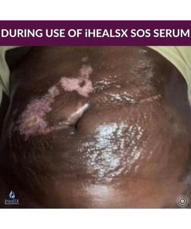 iHeal SX - SOS Serum - 2 oz (60ml) - Skin & Scar Serum - Cosmetic Surgery Scar Serum- BBL -Tummy Tuck - Breast Augmentation - Diabetic Wound Serum - Vitamin E - Buy Online on GoSupps.com
