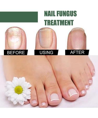 Antifungal Nail Treatment for Damaged Nails - Toe Care Solution for Renewing Discolored Feet - Buy Online on GoSupps.com