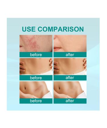 Advanced Scar Removal Spray for Surgical, Acne Scars & Stretch Marks - Skin Care (3pcs) - Buy Online on GoSupps.com
