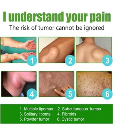 YSGBYSG LipomaCure Ointment 20g - 5PCS | Lump-Free Lipoma Removal Cream for Skin Anti-Swelling - Buy Online on GoSupps.com