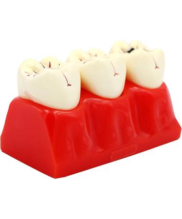 Buy Samnuerly 4-Fold Dental Teeth Caries Model - Removable Tooth Pathology & Evolutionary Display for Dental Training | International Shipping Available - Buy Online on GoSupps.com