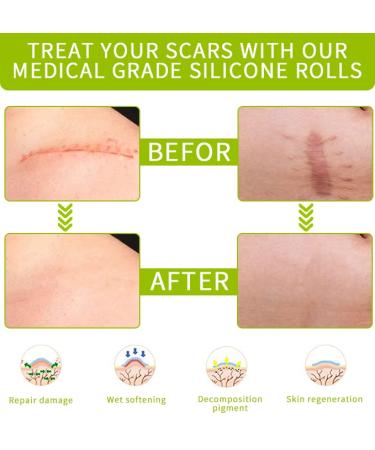 Silicone Scar Tape Roll (3M) - Reusable, Waterproof, 1.6 x 120 inches for Keloids, C-Section, Surgery, Burns, Acne - Scar Removal Treatment - Buy Online on GoSupps.com