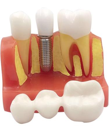 4x Dental Implant Teeth Model with Removable Crown - Crown & Bridge Dentist Training Tool for Patient Analysis | International Shipping - Buy Online on GoSupps.com