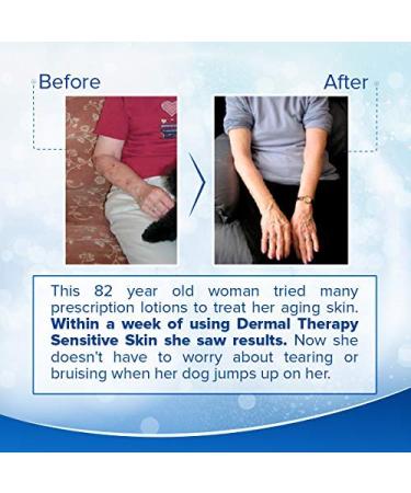 Dermal Therapy Sensitive Skin Lotion - 15% Allantoin & 10% Shea Butter for Eczema Relief - Soothing Non-Irritating Lotion - 8 fl oz / 240 ml - Buy Online on GoSupps.com