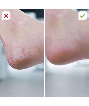 Buy Pedivac Electric Corn Removal Tool | Rechargeable Foot Care Device with 2 Attachments - Perfect Pedicure Solution | International Shipping Available - Buy Online on GoSupps.com