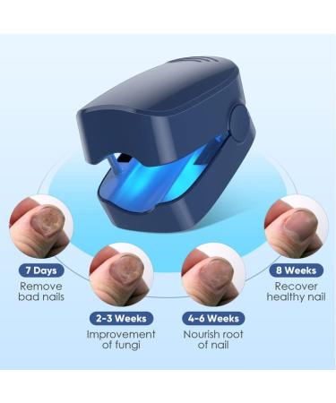 Nail Fungus Laser Treatment Device - Home Use Toenail & Fingernail Laser Cleaning Therapy - Buy Online on GoSupps.com