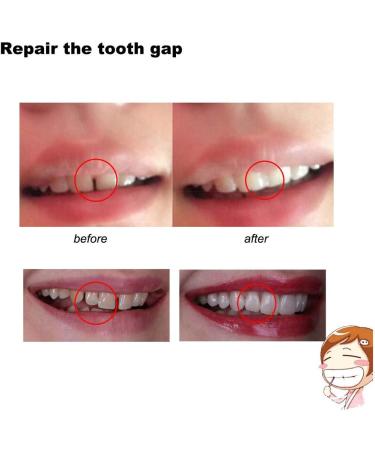 SowSmile 20g Temporary False Teeth Repair Beads - Light Yellow | Moldable Thermal Fitting for Instant Confident Smile - Buy Online on GoSupps.com