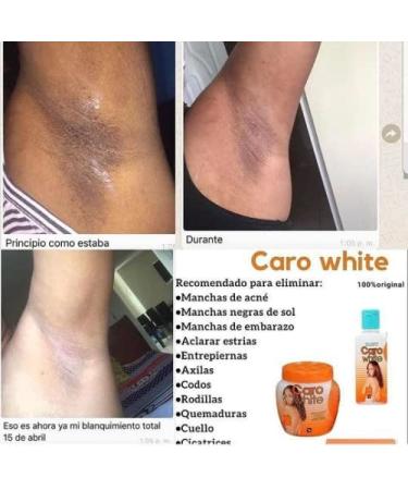 Buy Caro White Set - 3 (Lotion 10.14oz + Cream 10.14oz + Soap 6.3oz) | Best Skin Brightening Products Online | International Shipping Available - Buy Online on GoSupps.com
