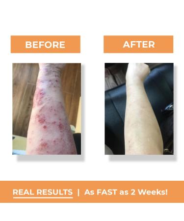 ECZEMA Relief - Colloidal Oatmeal Face & Body Lotion | Soothes Irritation & Inflammation | Natural Moisturizer - Clinically Tested - Buy Online on GoSupps.com