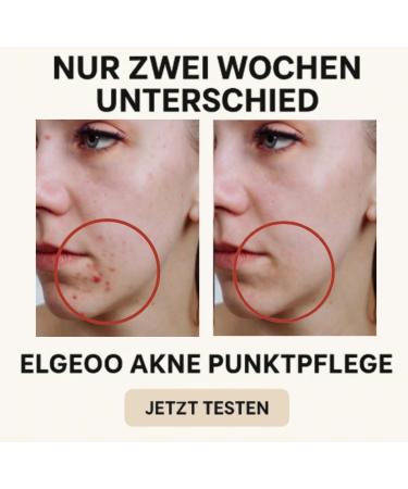  Generisch ELGEOO! Anti-acne treatment with 2% salicylic acid Anti-blemish cream for sensitive skin deep pore cleansing against pimples blackheads and impurities - Buy Online on GoSupps.com