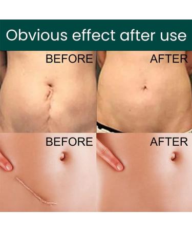 Fublazeze Scar Removal Paste - High Molecular Silicone Rubber for Trauma, Burn, and Skin Repair - Buy Online on GoSupps.com