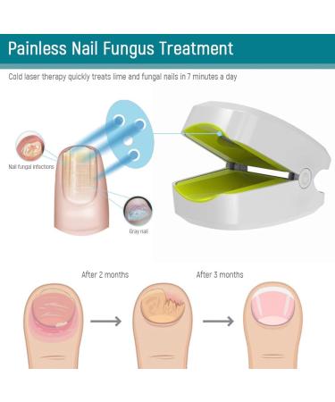 Lanlousy 905NM Nail Therapeutic Instrument Portable Painless Nail Therapy Device Anti- Silicone Easy to Use White - Buy Online on GoSupps.com