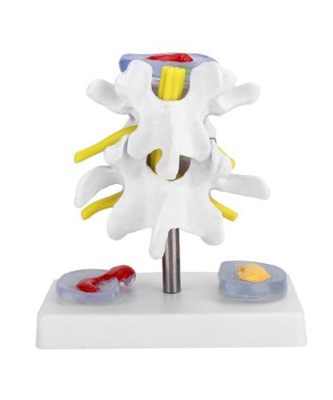 Anatomical lumbar intervertebral disc demonstration model of an intermediate vertebral incident model of the lumbar spine training material for the human spine