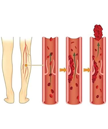 Mandurs 72Pcs Varicose Veins Patch - VeinHealth Treatment for Legs | Improve Blood Circulation, Reduce Pain & Swelling - Buy Online on GoSupps.com
