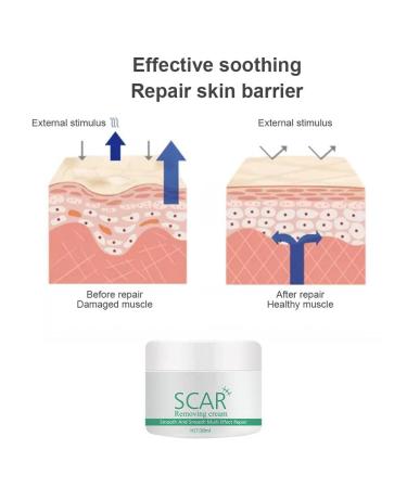 Hotiary Plant Scar Repair Cream - Acne & Stretch Mark Remover for Scars, Burns, Postoperative Skin - Men & Women - Buy Online on GoSupps.com