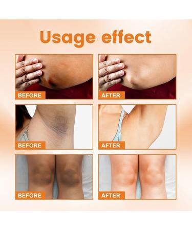 Dark Spot Remover for Private & Bikini Area | Vitamin C Skin Lightening Serum | Brighten Body Neck Armpit Elbow & Knees (1.8 Oz - Buy Online on GoSupps.com