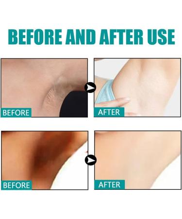 Skin Whitening Serum Skin Lightening Serum For Body Underarms Armpit Knees and Inner Thigh Dark Spot Remover Corrector Cream for Body Hyperpigmentation Treatment 1 - Buy Online on GoSupps.com