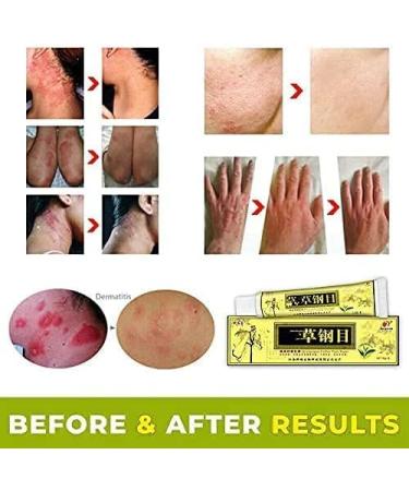 Natural Herbal Cream for Itching Allergy, Dry Skin Relief - Eczema Treatment - Buy Online on GoSupps.com