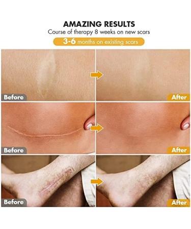 Silicone Scar Sheets 8 PCS Reusable Silicone Sheets for Scar Removal Professional Gel Scar Repair Treatment for Skin Trauma Surgery Burn Acne C-Section Scars White - Buy Online on GoSupps.com