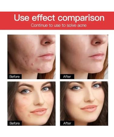 Acne Pimple Patch - Hydrocolloid Spot Stickers for Face & Body | 120 Count No Toxic Ingredients Cruelty-Free - Buy Online on GoSupps.com
